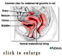 Acupuncture & Herbal Medicine Can Effectively Manage Endometriosis